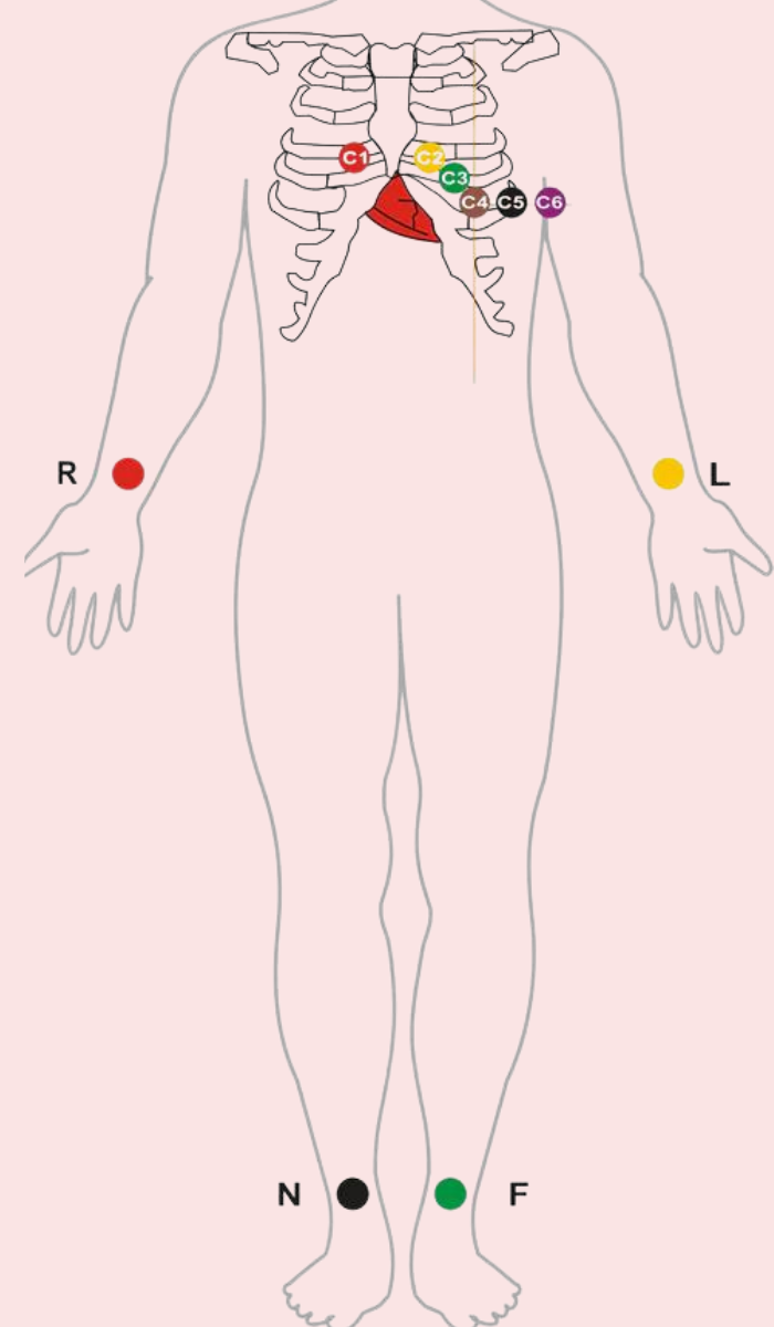 Ekg Positioning 12 Lead Ecg Placement Diagram 12 Lead Placement Guide With Diagram